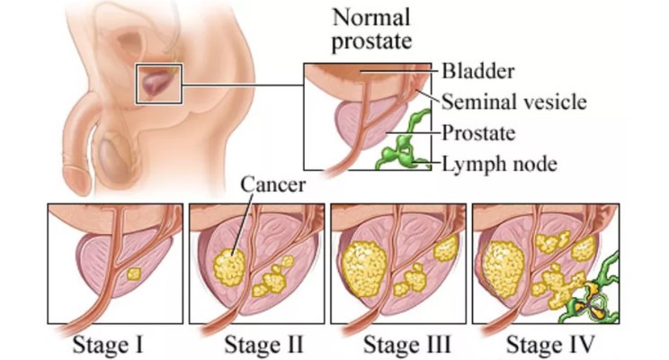 prostate cancer